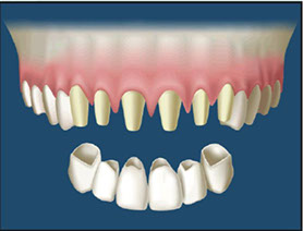 To eliminate the look of longer teeth, porcelain veneers or crowns are made.