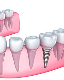 dental implants in los algodones mexico